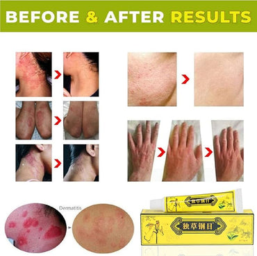5 unids chino herbario crema dermatitis y eccema prurito psoriasis ungüento