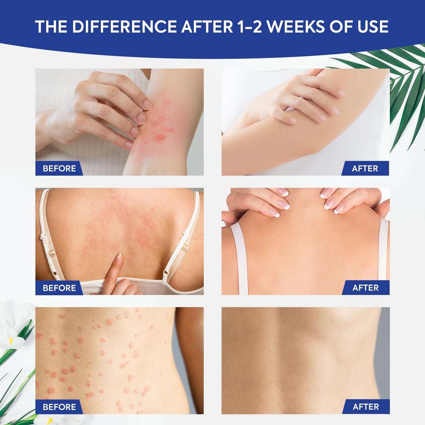 Crema antifúngica para la picazón Charmpoo - La Tiendita de la Jose