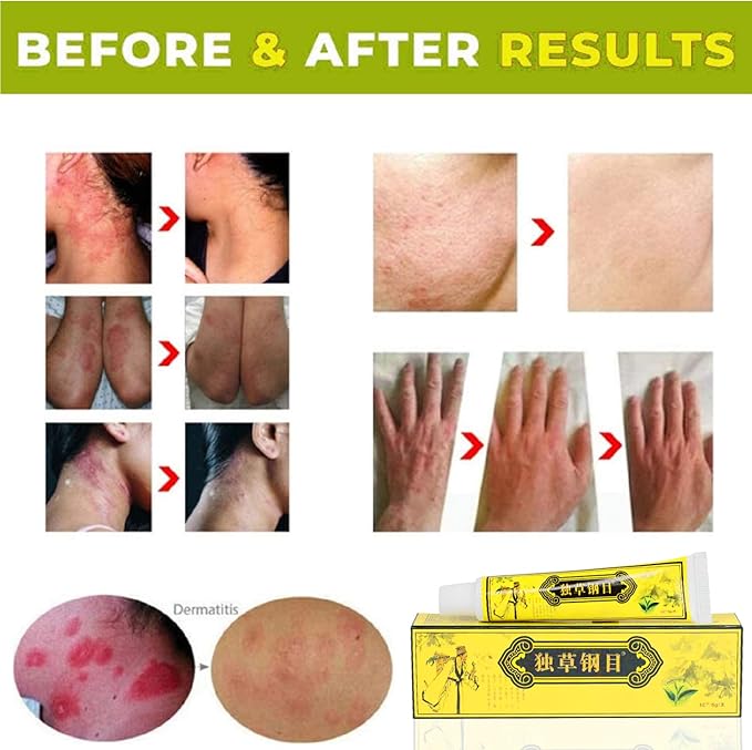 5 unids chino herbario crema dermatitis y eccema prurito psoriasis ungüento